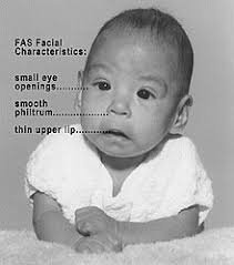 chrisean rock baby disease